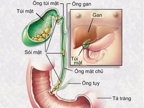 Sỏi đường mật phải làm sao? dịch mật gây đầy trướng