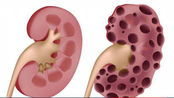 Sỏi hệ tiết niệu gây đau như thế nào?