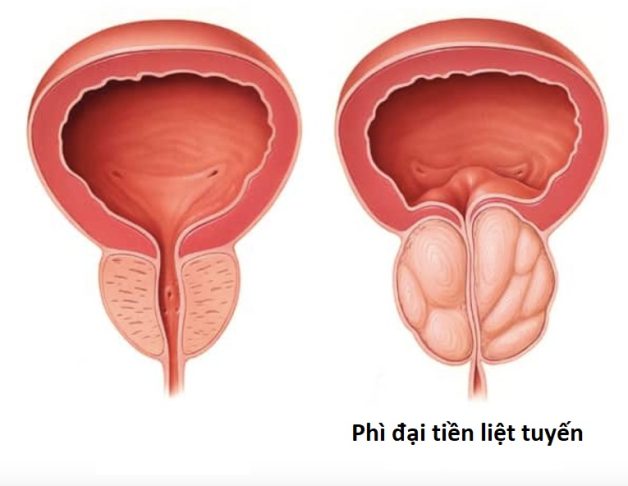 Sỏi kẹt cổ bàng quang – Mức độ nguy hiểm và cách điều trị