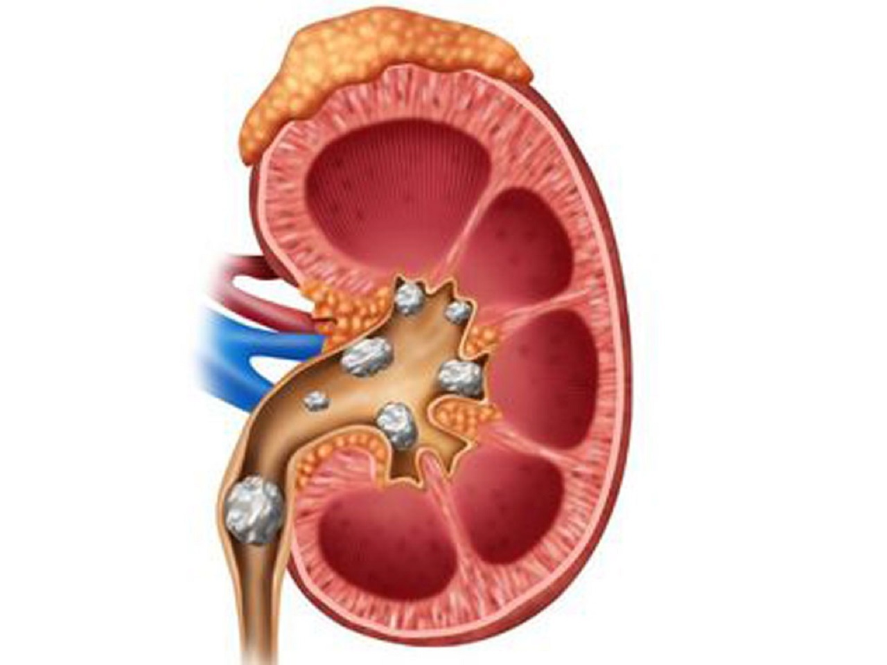 Sỏi kẹt niệu quản có nguy hiểm không – Góc giải đáp