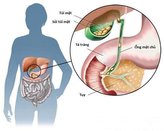 Nhiều người có rất nhiều sỏi trong túi mật nhưng không biết chỉ khi đi thăm khám với bác sĩ mới "ngỡ ngàng" phát hiện ra. 