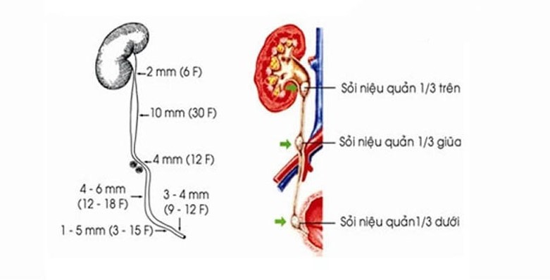 Sỏi niệu quản 1/3 giữa điều trị như thế nào? Góc giải đáp