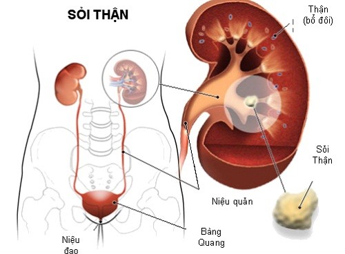 Sỏi niệu quản có nguy hiểm không?