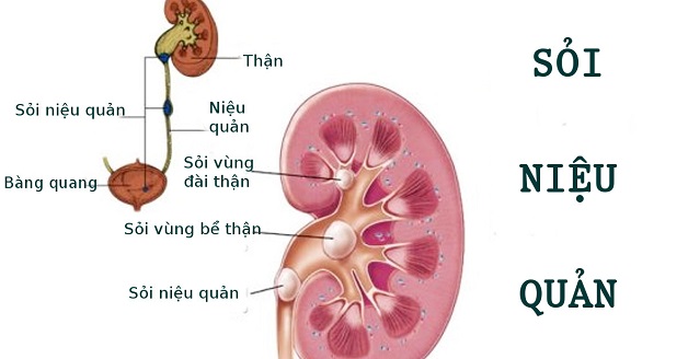 soi nq1