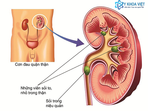 Sỏi niệu quản làm sao để loại bỏ?