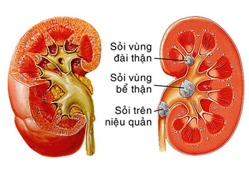 Sỏi niệu quản làm sao để loại bỏ?