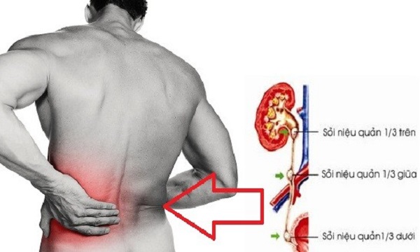 Sỏi niệu quản: nguyên nhân, triệu chứng, chẩn đoán