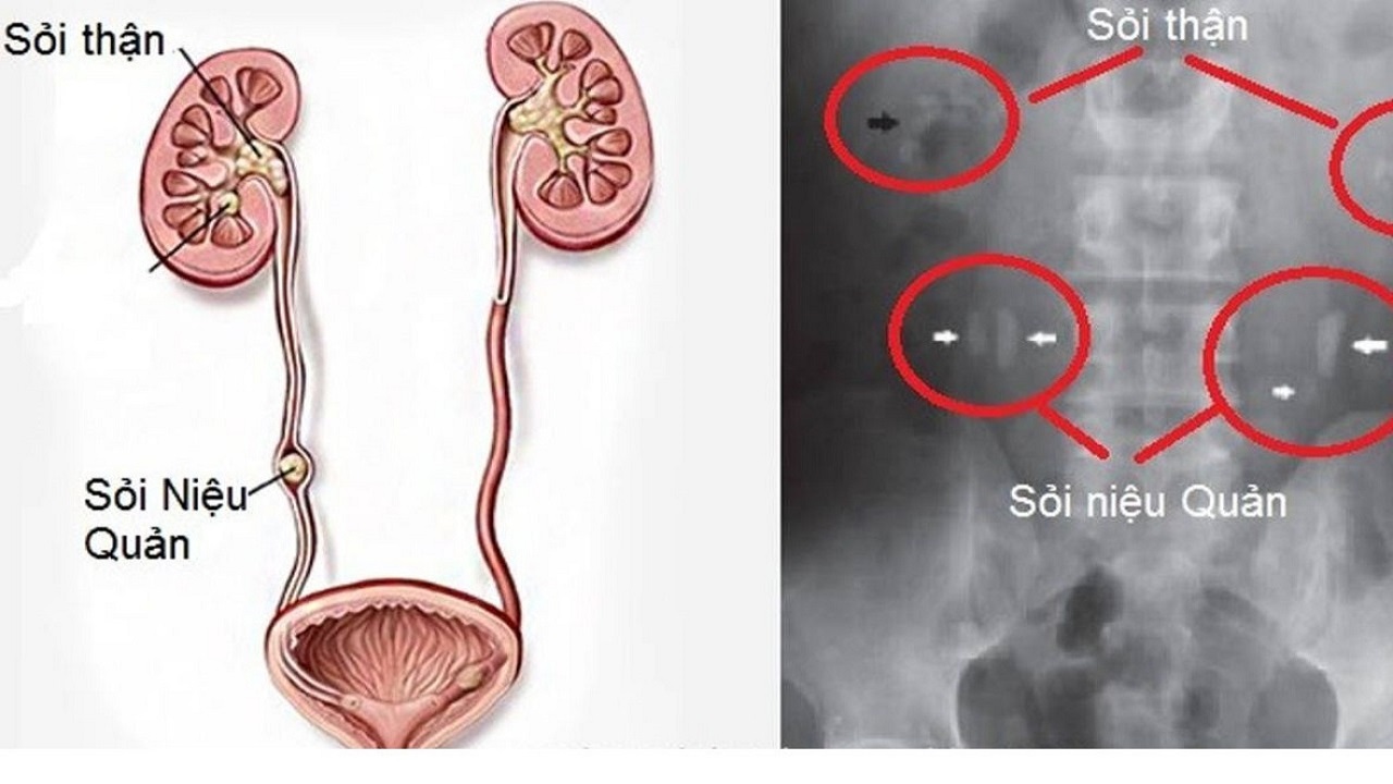 Sỏi niệu quản| Nguyên nhân, triệu chứng và cách điều trị