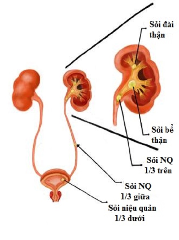 Sỏi niệu quản và nội soi sau phúc mạc lấy sỏi niệu quản