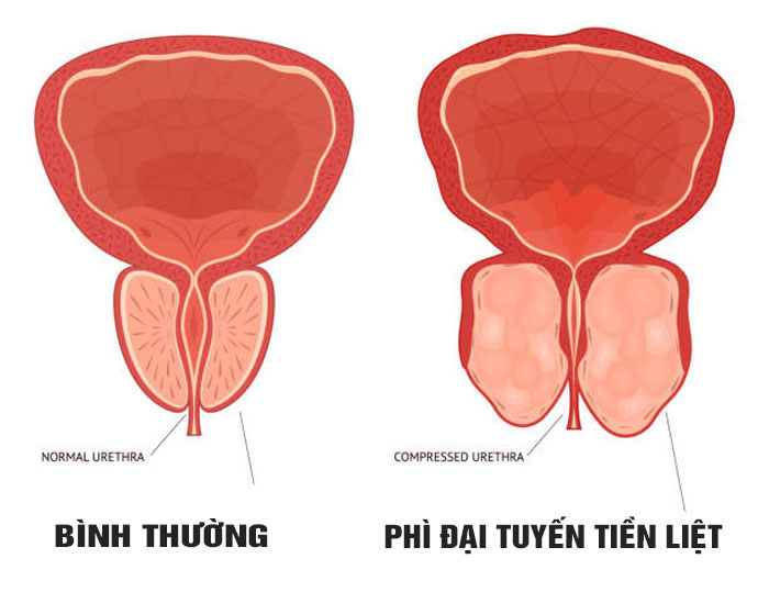 Sỏi ở bàng quang: Nguyên nhân và cách điều trị