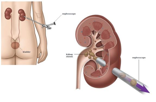 Sỏi san hô: Biểu hiện và cách điều trị hiệu quả