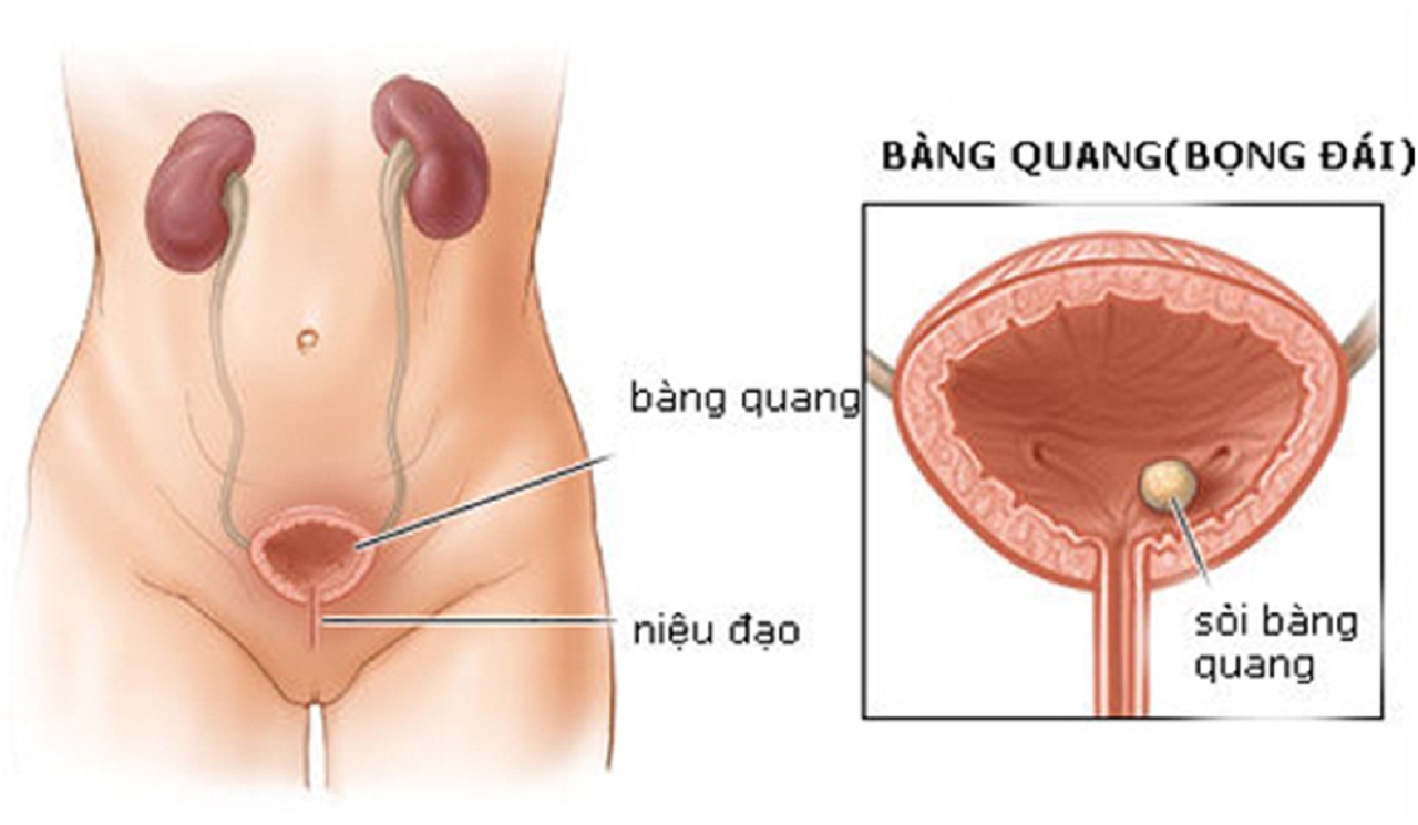 Sỏi thận bàng quang: Biến chứng, chẩn đoán và điều trị