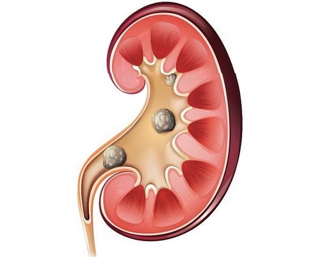 Sỏi thận bàng quang: Biến chứng, chẩn đoán và điều trị