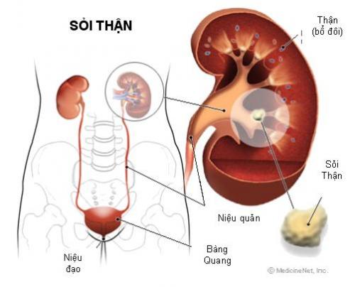 Sỏi thận cách điều trị ăn uống và sinh hoạt không hợp lý