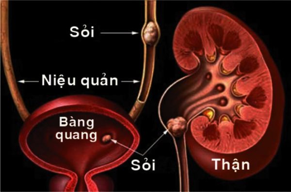 Sỏi tiết niệu và những phương pháp tán sỏi Công Nghệ Cao