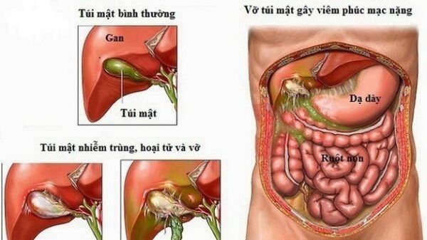 Sỏi túi mật có chữa được không?