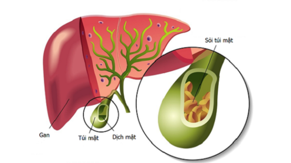 Sỏi túi mật và phác đồ điều trị sỏi túi mật hiệu quả nhất