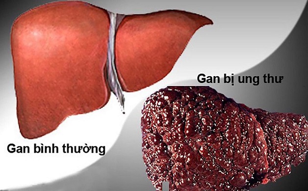 Sống chung với người bị ung thư gan có lây không? 