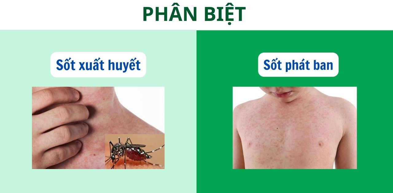 Sốt xuất huyết và sốt phát ban: Phân biệt tránh hậu quả nguy hiểm