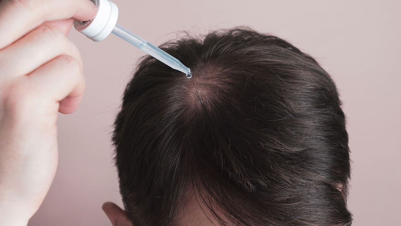 Sử dụng Minoxidil đúng cách để đạt hiệu quả tốt nhất