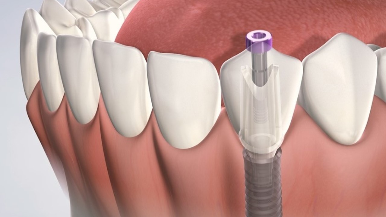 Sự thật đằng sau nhiều quảng cáo trồng răng sứ giá rẻ