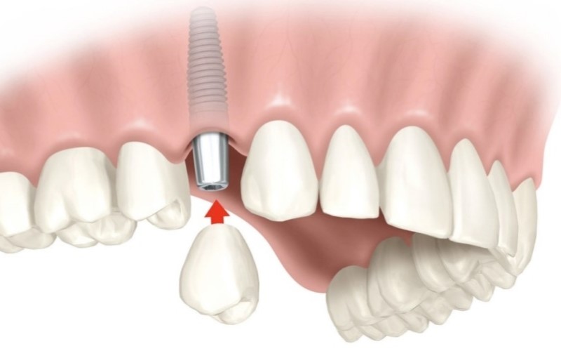 Sự thật đằng sau nhiều quảng cáo trồng răng sứ giá rẻ