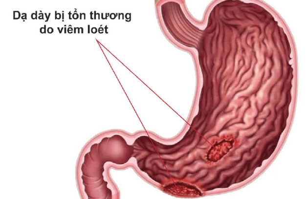 Sự thật về đau dạ dày mà buồn nôn