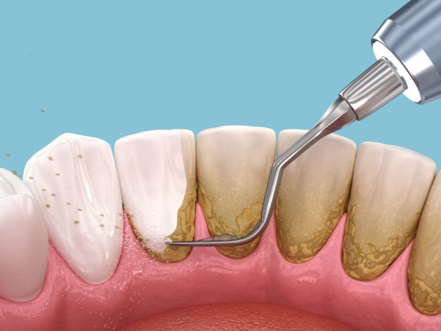 Sự thật về nước súc miệng loại bỏ cao răng