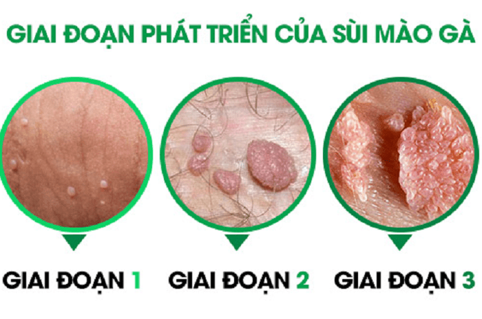 Sùi mào gà ở nam giới giai đoạn đầu