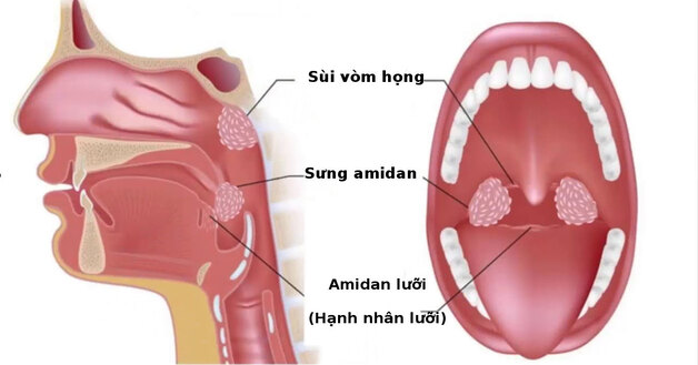 Sưng amidan nên làm gì để giảm đau, phục hồi hiệu quả