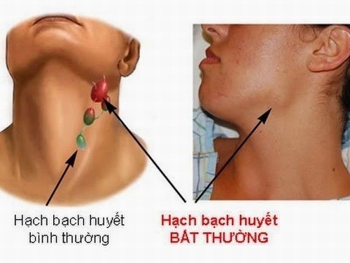 Sưng hạch bạch huyết chớ chủ quan