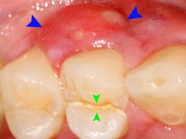 Sưng lợi răng hàm – biểu hiện của một số bệnh lý