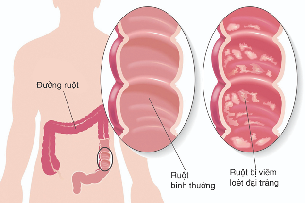 Sưng ruột già – Những điều bạn chưa biết 