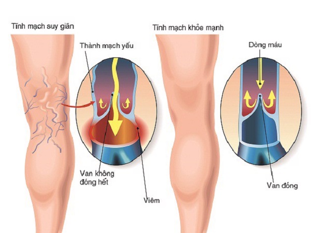 Suy giãn tĩnh mạch chi dưới và cách chẩn đoán, điều trị