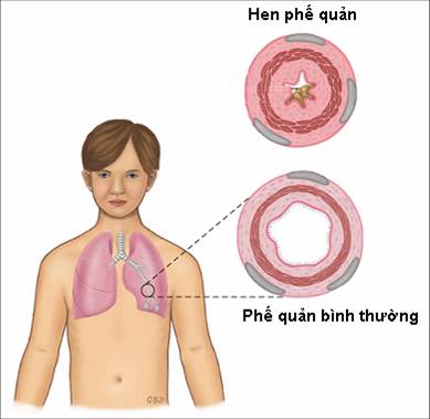 Suy hô hấp cấp ở trẻ em đừng để biến chứng rồi mới tìm cách cứu chữa