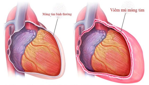 Suy nút xoang tim: Nguyên nhân, triệu chứng và điều trị