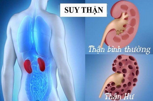 Suy thận có chữa khỏi được không?