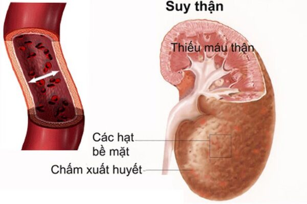 Suy thận nhẹ có chữa khỏi được không?