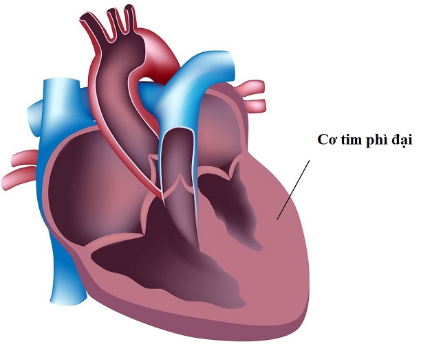 Suy tim cấp: Nguyên nhân, triệu chứng, chẩn đoán, điều trị