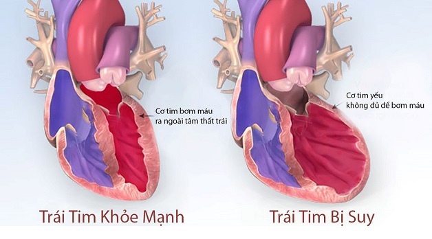 Suy tim sung huyết: Nguyên nhân, chẩn đoán và điều trị