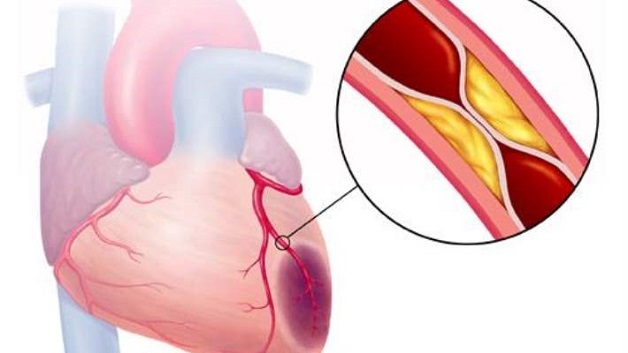 Tắc động mạch vành nguy hiểm như thế nào?