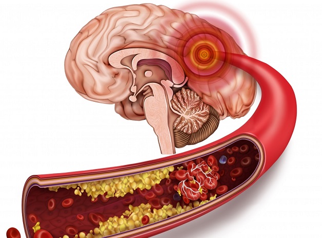 Tắc mạch máu não: Nguyên nhân, triệu chứng và cách xử trí