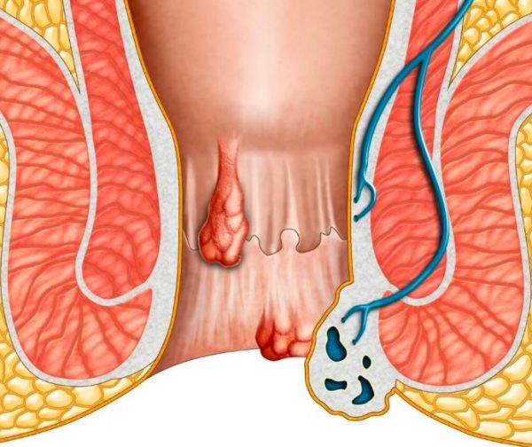 Tắc mạch trĩ ngoại và những điều cần biết