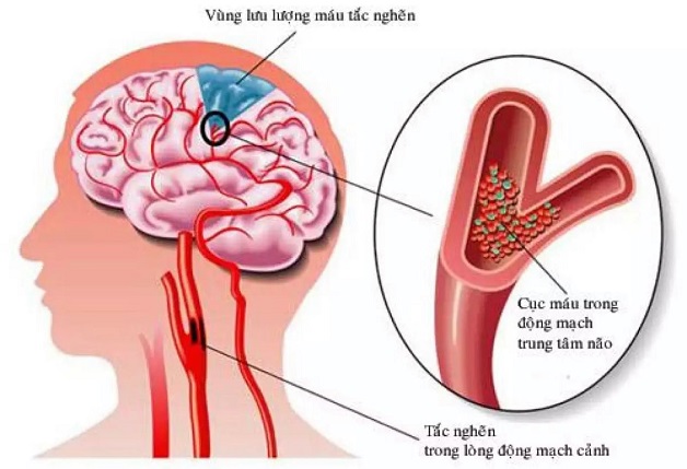 Tắc nghẽn mạch máu não: Đột quỵ chực chờ