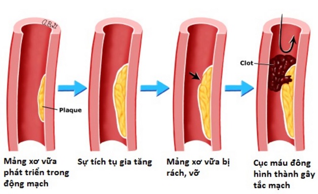 Tắc nghẽn mạch máu não: Đột quỵ chực chờ