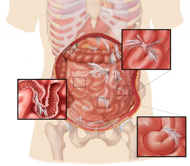 Tắc ruột non được phát hiện và điều trị như thế nào?