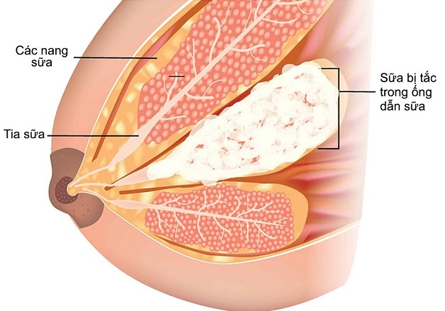 Tắc tia sữa: nguyên nhân và biểu hiện nhận biết