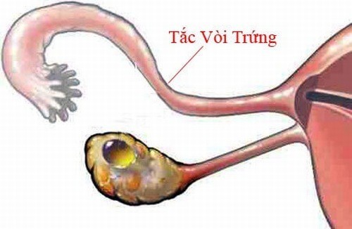 Tắc vòi trứng có mang thai được không?