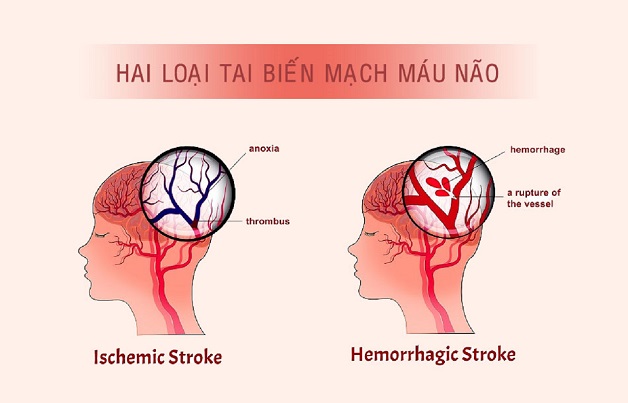 Tai biến mạch máu não bệnh học và triệu chứng