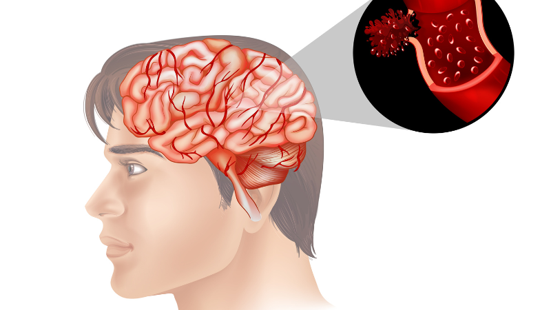 Tai biến mạch máu não: Bộ Y tế khuyến cáo